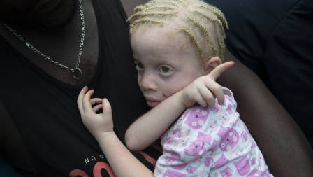 Child with albinism and mother